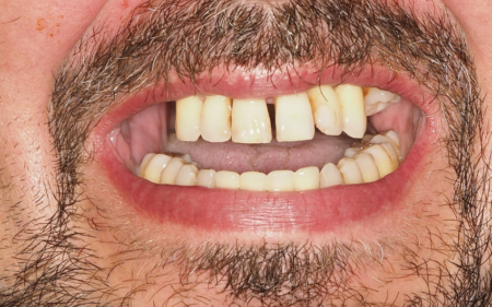 Consecuencias de la falta de dientes