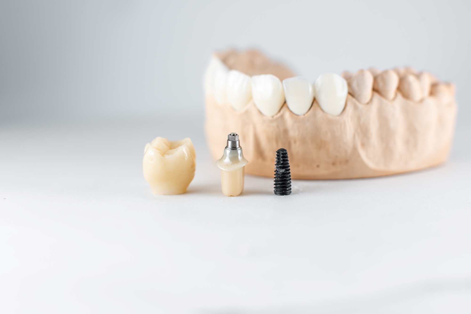 Cuánto tiempo duran los implantes dentales