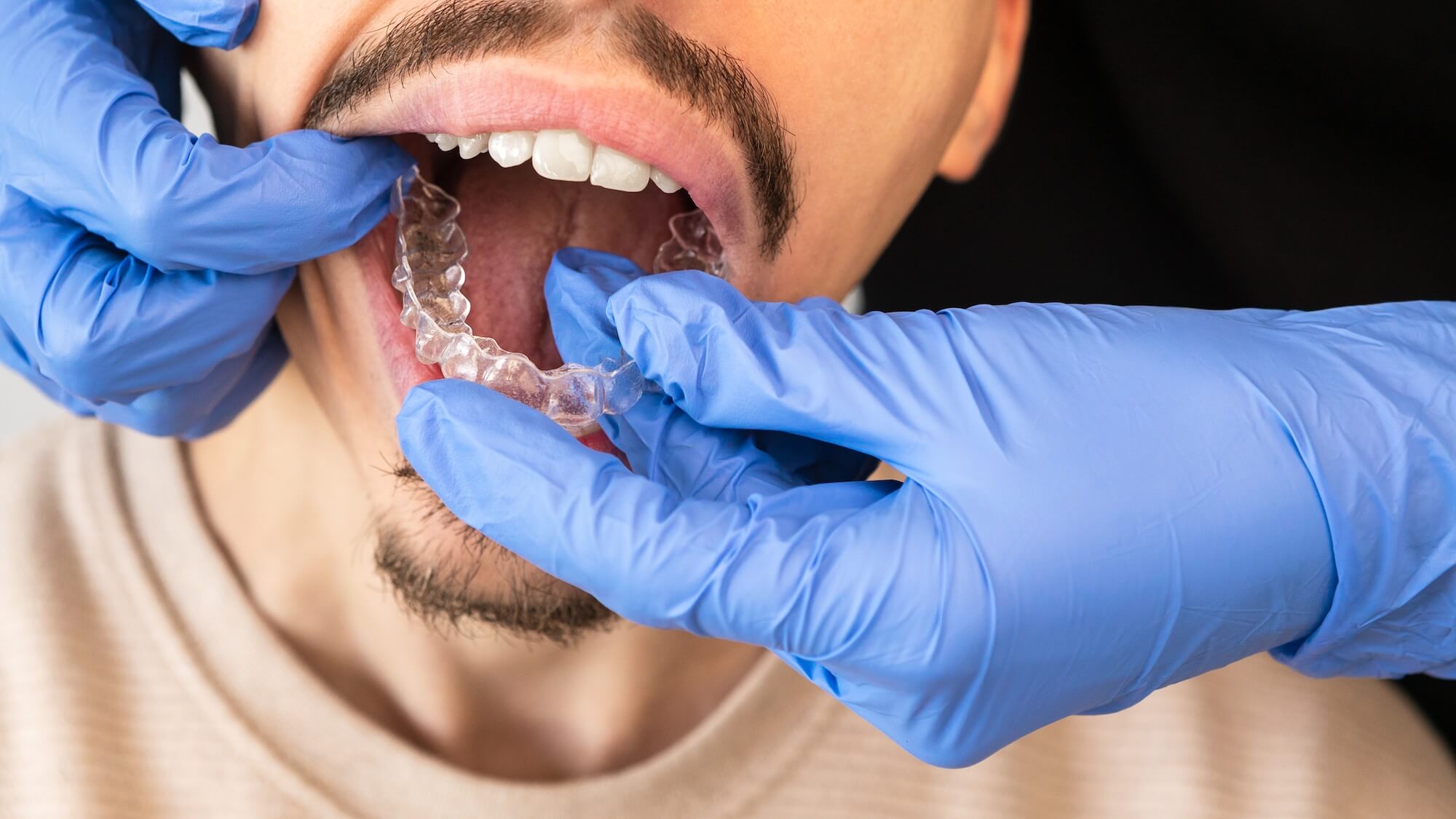 Maloclusión dental: qué es y cómo solucionarlo
